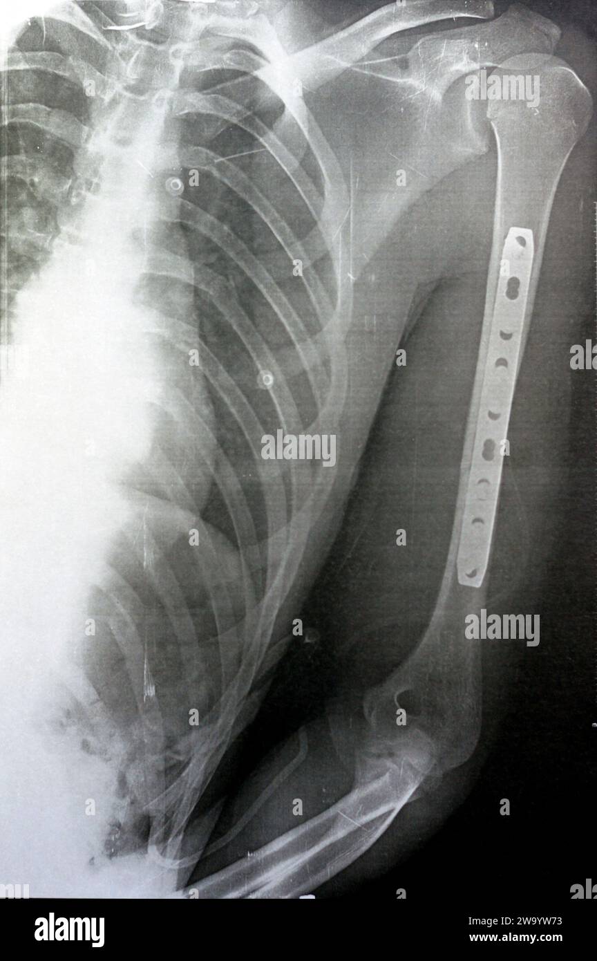 Radiografia semplice che mostra frattura dell'omero sinistro dell'albero intermedio trasversale causata da un trauma diretto in un incidente stradale, gestito da riduzione aperta e fissa interna Foto Stock