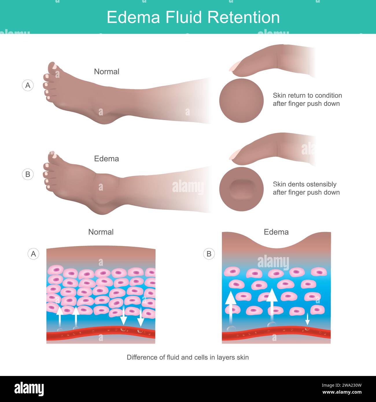 Ritenzione di liquido edema. Ammaccature sulla pelle dopo la pressione del dito verso il basso sulla gamba risultato del sintomo edema. Illustrazione Vettoriale