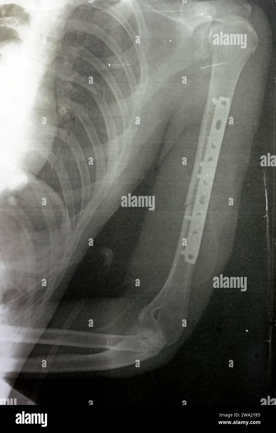 Radiografia semplice che mostra frattura dell'omero sinistro dell'albero intermedio trasversale causata da un trauma diretto in un incidente stradale, gestito da riduzione aperta e fissa interna Foto Stock