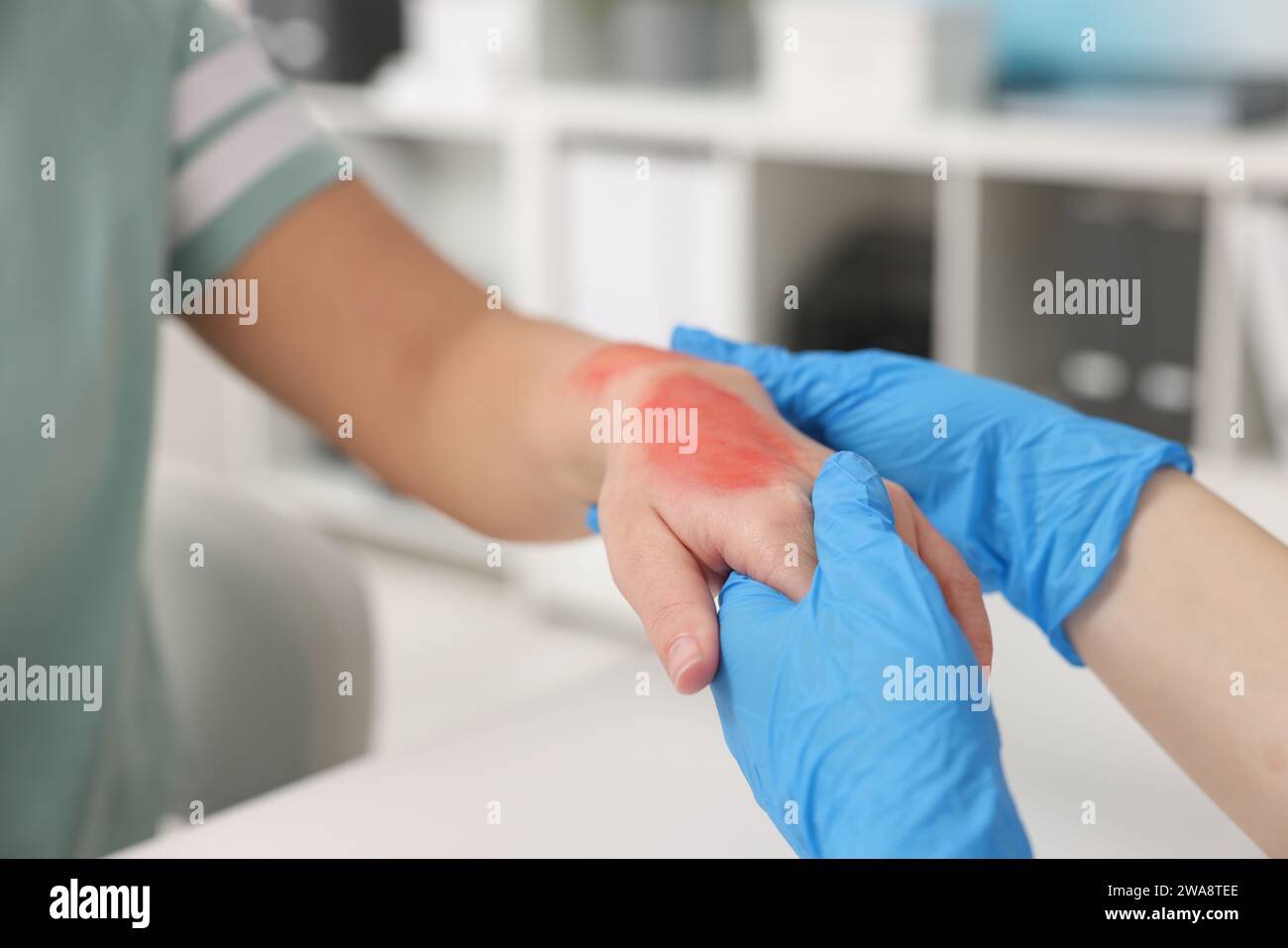 Medico che esamina la mano bruciata del paziente al chiuso, primo piano Foto Stock