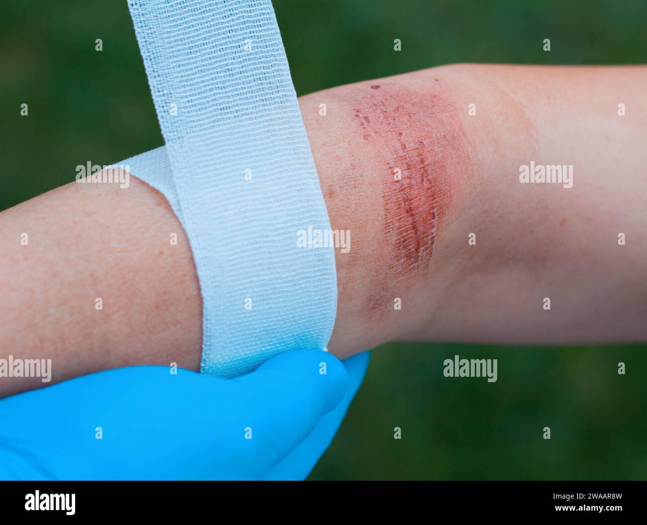 Medico di guarigione a mano un olocausto area della pelle Foto Stock