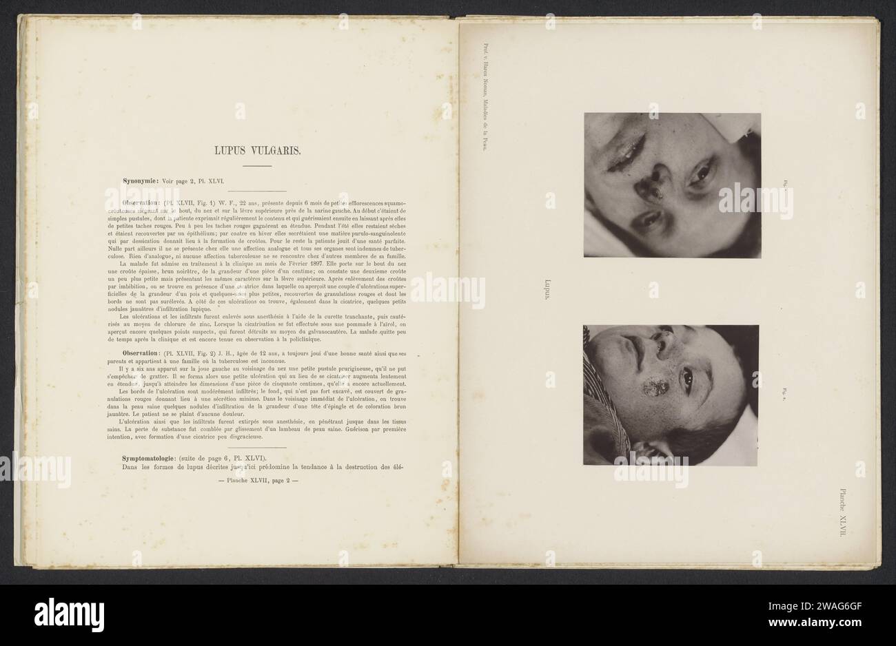 I pazienti soffrono della malattia della pelle 'lupus', c. 1887 - in o prima 1897 stampa fotomeccanica Amsterdampublisher: Haarlem carta collotipo pelle e malattie veneree. bambino. faccia Foto Stock