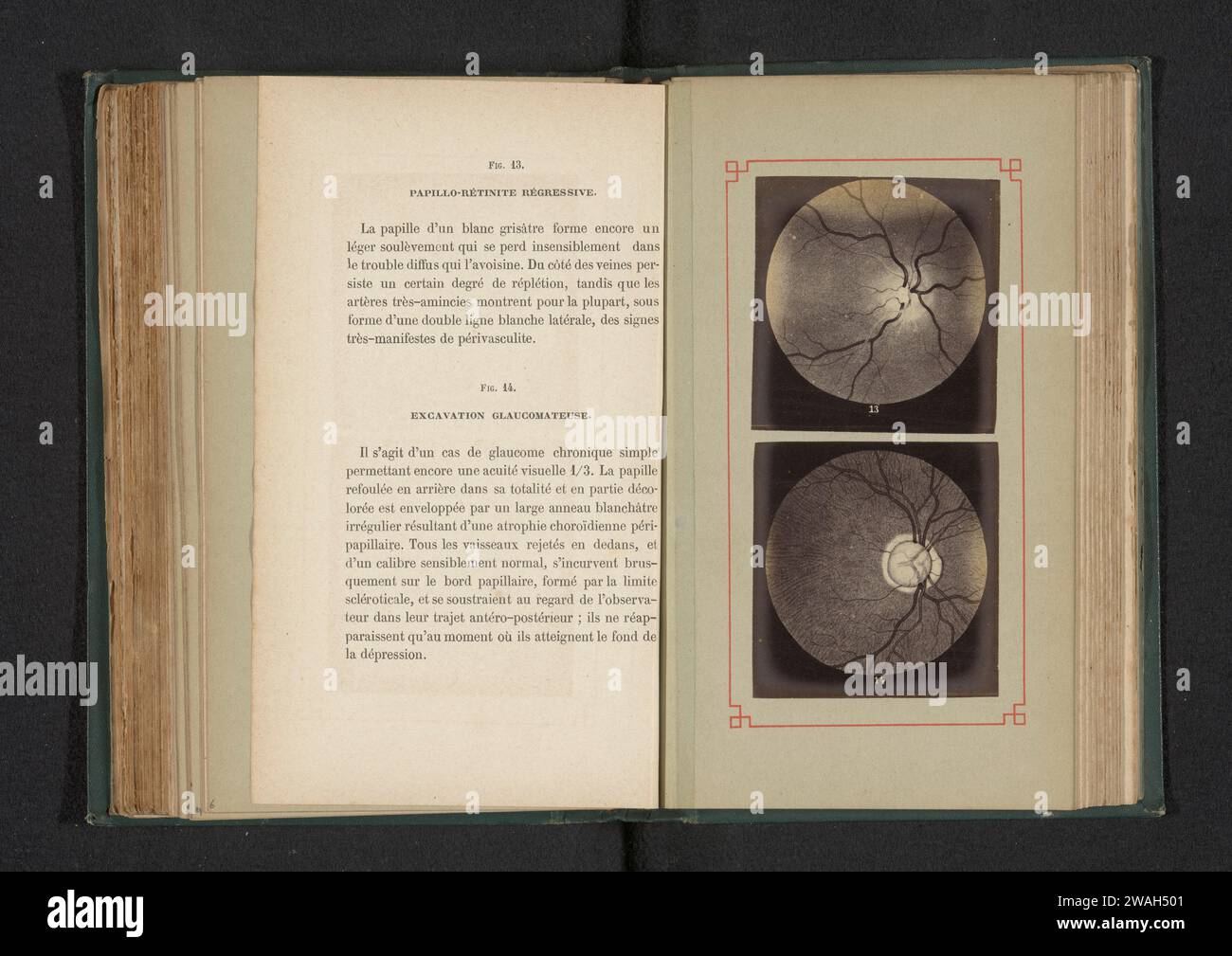 Produzione fotografica di due disegni anatomici di un'infiammazione regressiva di un disco ottico e distorsione di un occhio da glaucoma, anonimo, c. 1871 - in o prima del 1881 fotografia supporto fotografico albume stampa occhi. anatomia (non medica) Foto Stock