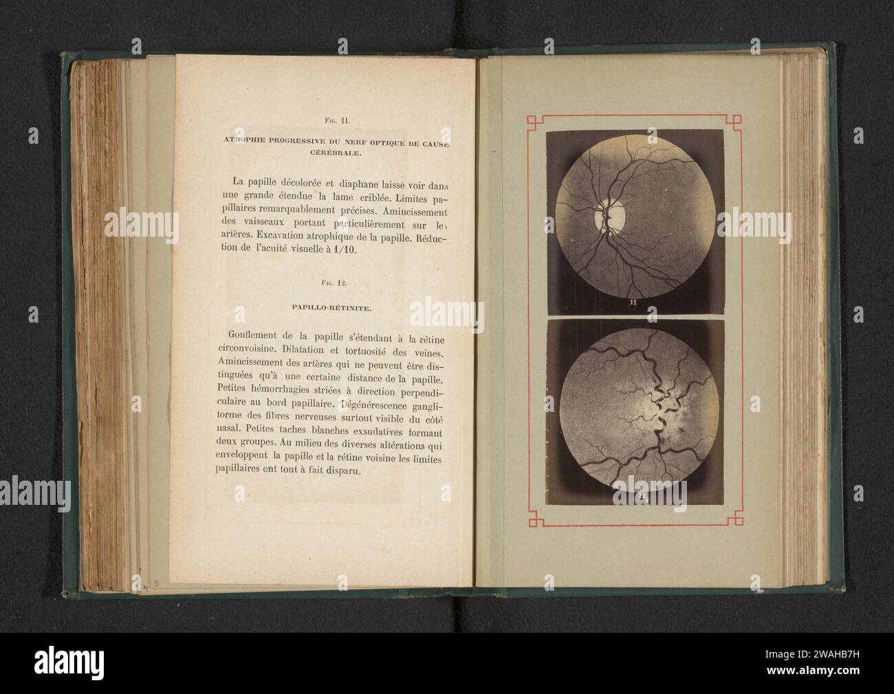 Produzione fotografica di due disegni anatomici di atrofia progressiva del nervo ottico e di un'infiammazione di un disco ottico, anonimo, c. 1871 - in o prima del 1881 fotografare il supporto fotografico degli occhi di stampa di albumi. anatomia (non medica) Foto Stock