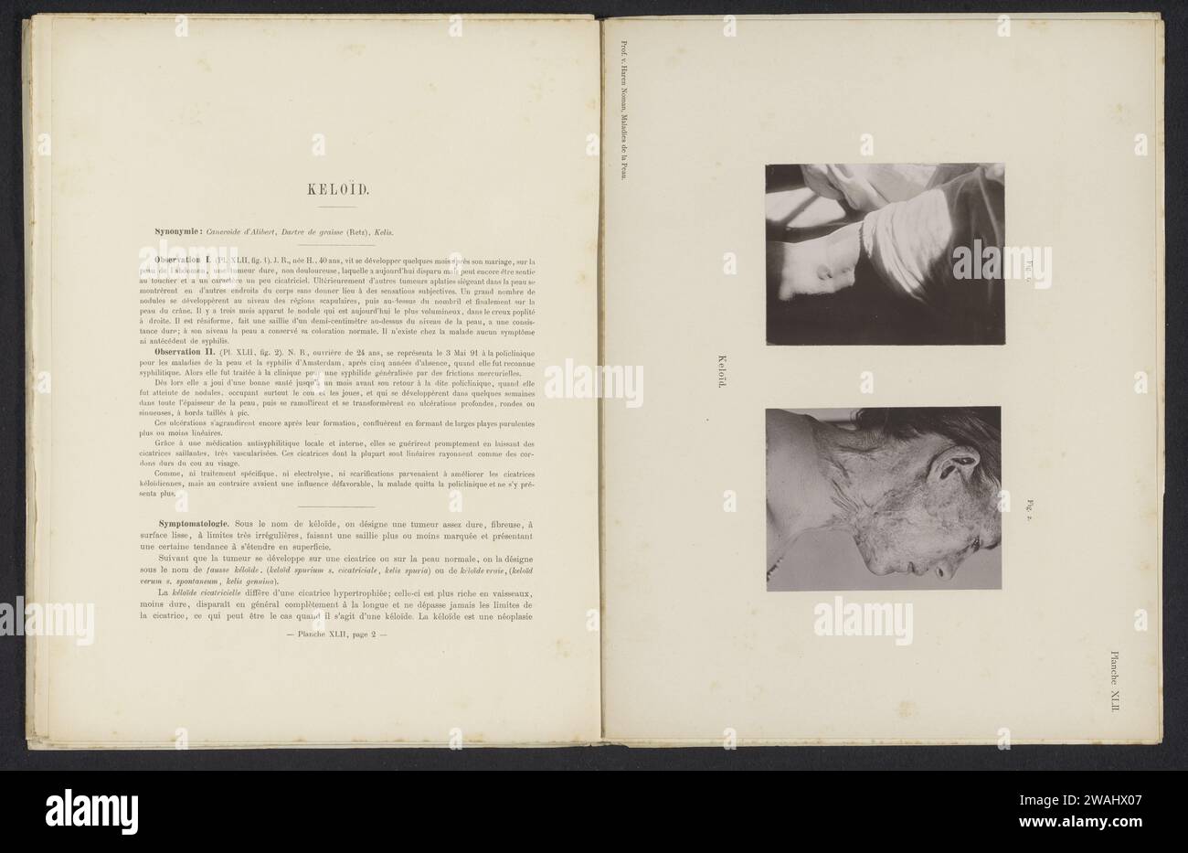 Pazienti affetti da malattia della pelle 'keloid', c. 1890 - in o prima 1900 stampa fotomeccanica Amsterdampublisher: Haarlem carta collotipo pelle e malattie veneree. armi. faccia Foto Stock
