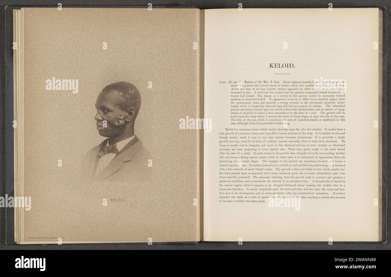 Paziente che soffre di malattia della pelle 'keloid', c. 1870 - in o prima 1881 stampa fotomeccanica New York (città) carta collotipo pelle e malattie veneree. uomo adulto Foto Stock