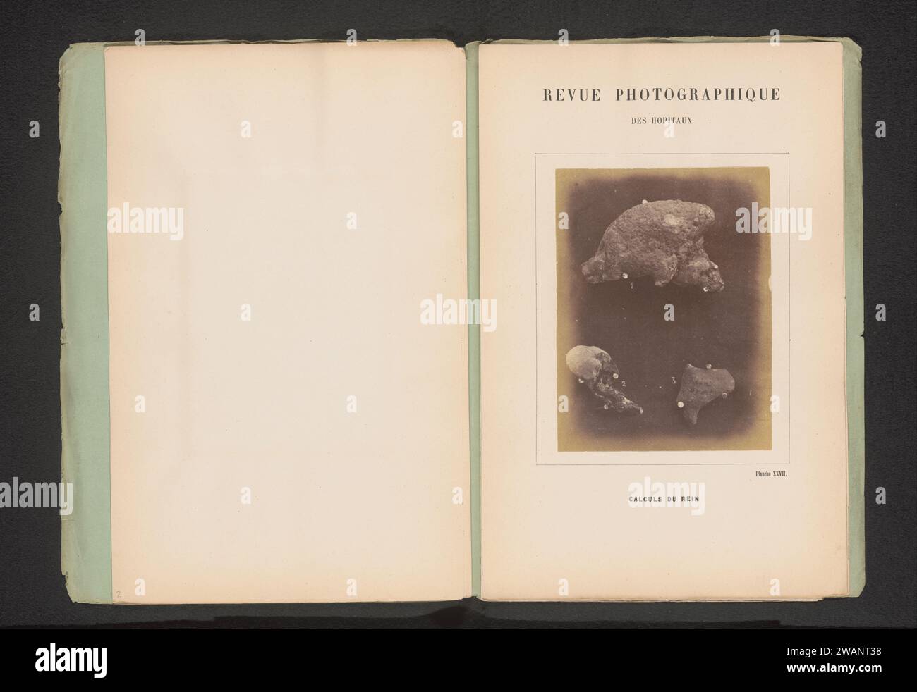 Vista di Rene pietre, Anonimo, c. 1865 - in o prima 1870 fotografia carta albumen stampa ricerca medica, rami della medicina Foto Stock