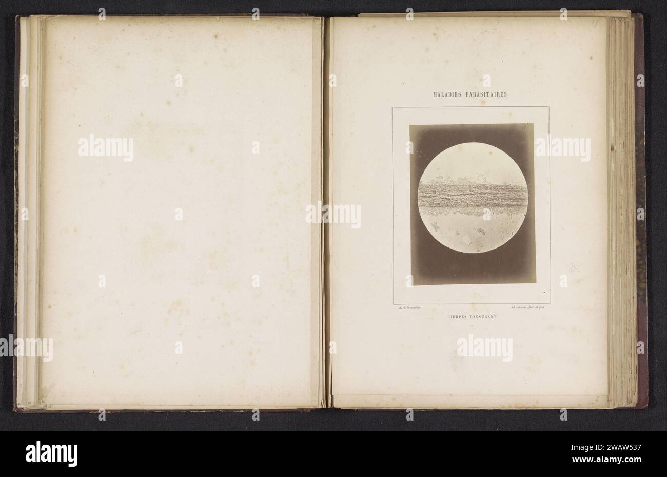 Assunzione microscopio di tigna sulla testa, A. de Montméja, c. 1860 - c. 1868 foto supporto fotografico albume stampa pelle e malattie veneree Foto Stock