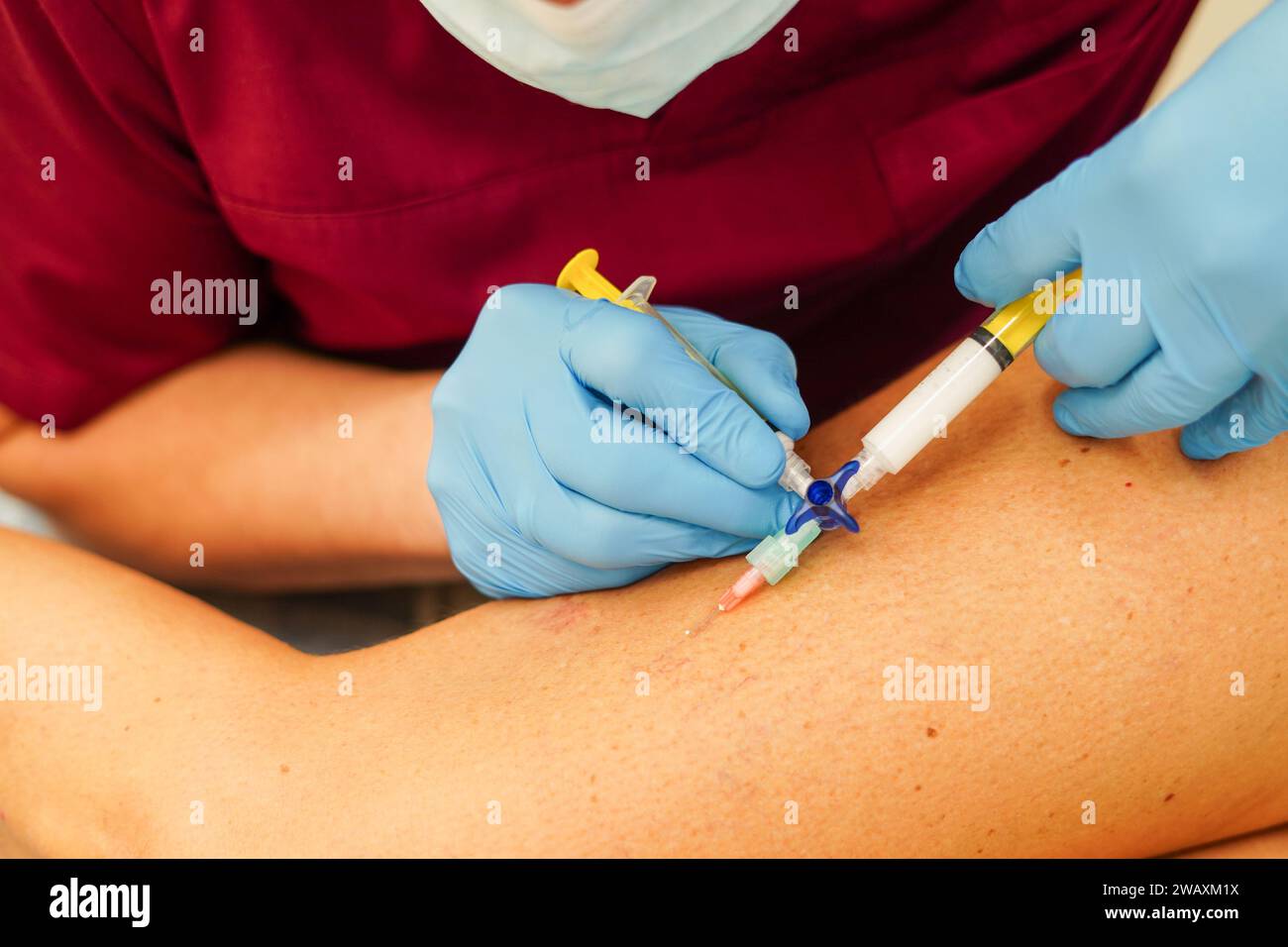 Rimozione delle vene varicose sulle gambe. Dottore che fa scleroterapia Foto Stock