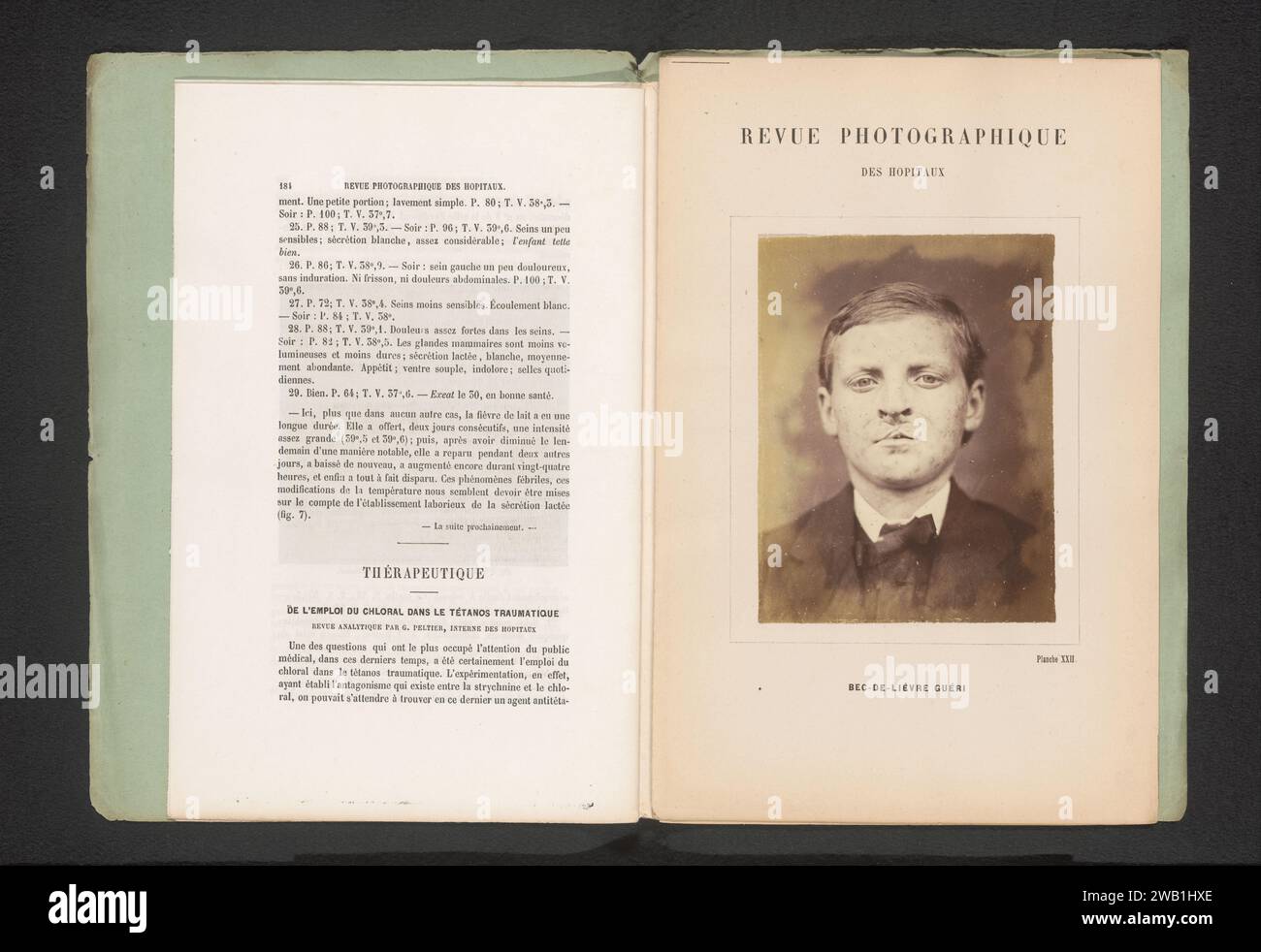 Ritratto di un ragazzo sconosciuto con un labbro fessurato dopo l'intervento chirurgico, anonimo, c. 1865 - in o prima 1870 foto carta albumen stampa ricerca medica, rami della medicina. lepre-lip. persone storiche. giovani, adolescenti Foto Stock