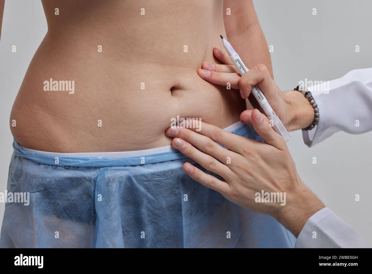 Il medico fa dei contrassegni con un marcatore prima dell'operazione di ripiegamento sul pancino, addominoplastica Foto Stock