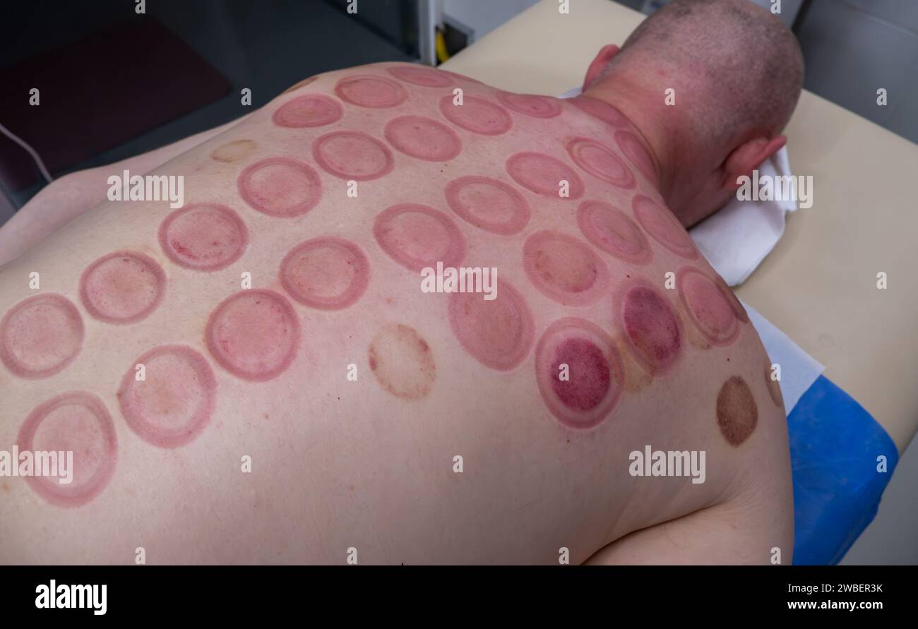 Tracce rosse sulla pelle maschile dopo il trattamento con l'aspirapolvere Cupping primo piano. Antica medicina alternativa cinese. Foto Stock