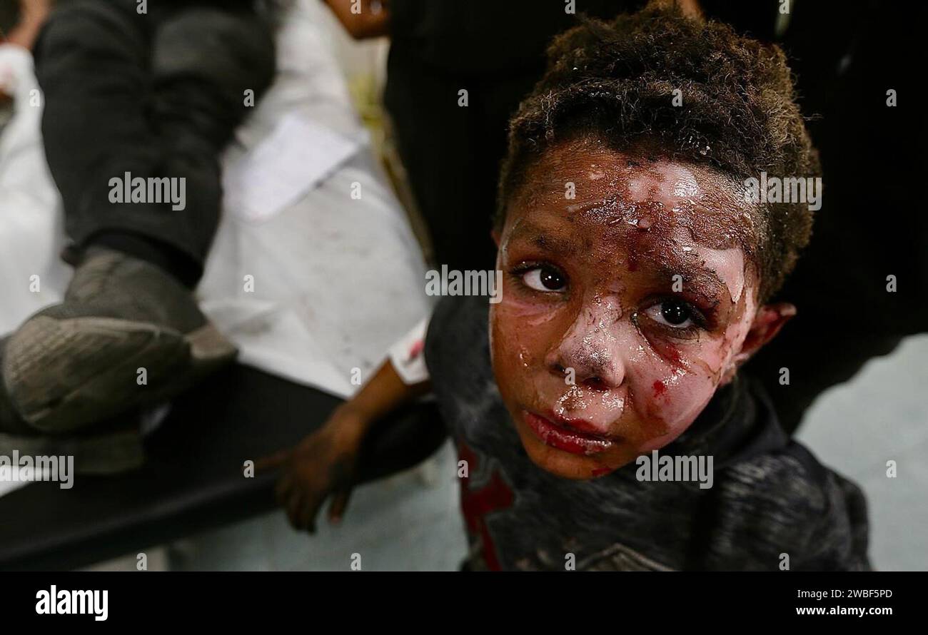 Un bambino palestinese il cui volto è stato bruciato a causa di un bombardamento israeliano di una casa a Rafah, a sud della Striscia di Gaza. Palestina. Foto Stock