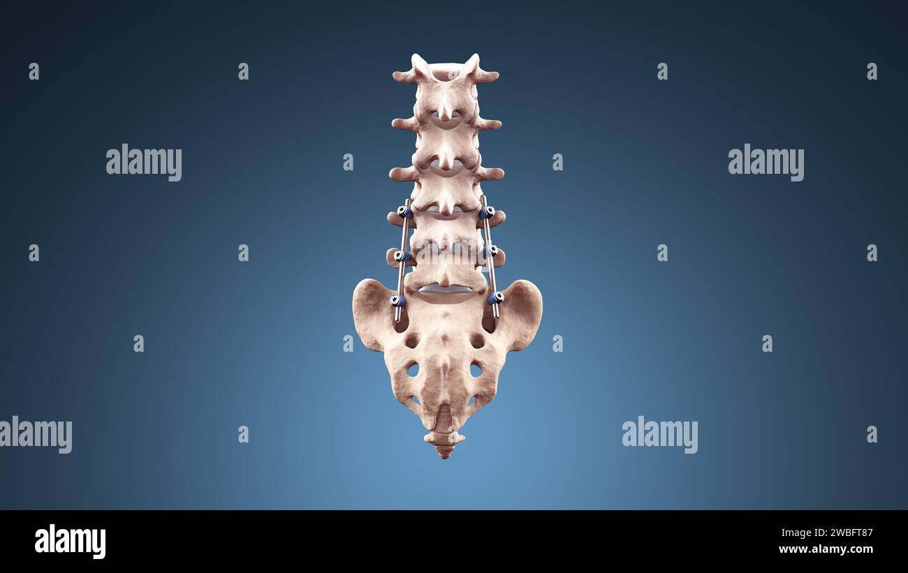 Fusione dorsale posteriore lombare con viti e aste per pedicle Foto Stock