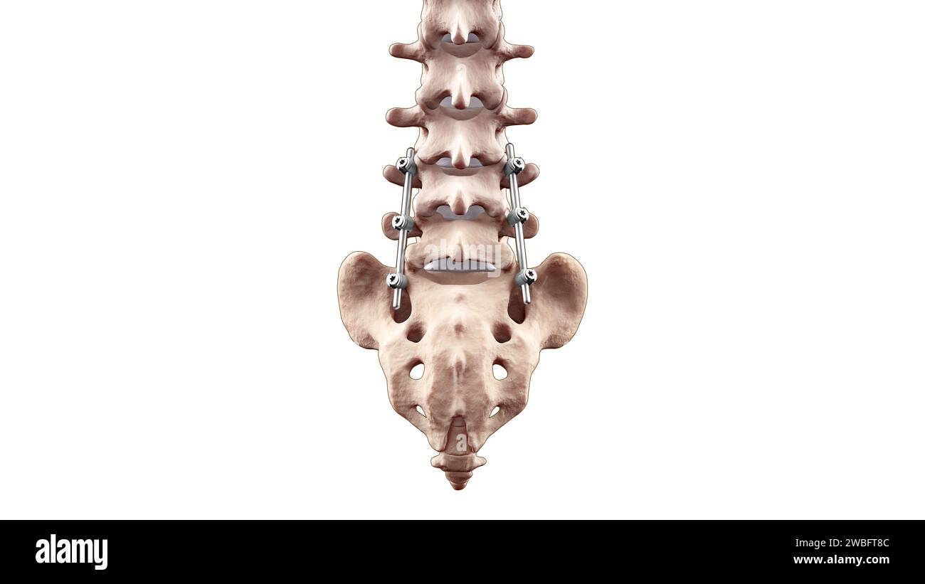 Fusione dorsale posteriore lombare con viti e aste per pedicle Foto Stock