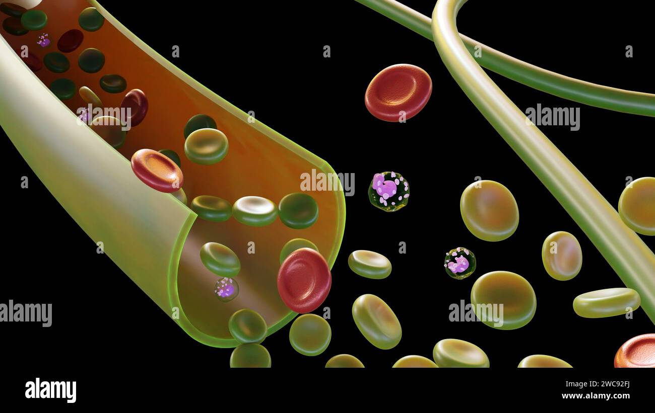 Sulfemoglobinemia, una condizione caratterizzata da livelli anormalmente elevati di sulfemoglobina (SulfHb) nel sangue, può causare la comparsa di verde nel sangue Foto Stock