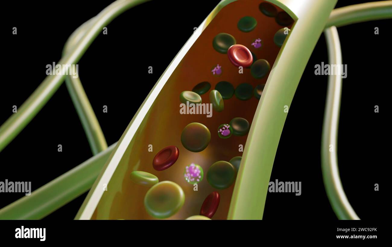 Sulfemoglobinemia, una condizione caratterizzata da livelli anormalmente elevati di sulfemoglobina (SulfHb) nel sangue, può causare la comparsa di verde nel sangue Foto Stock