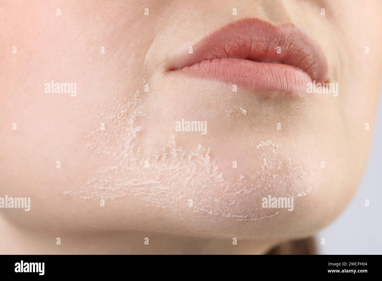 Vista ravvicinata di una donna con pelle secca Foto Stock
