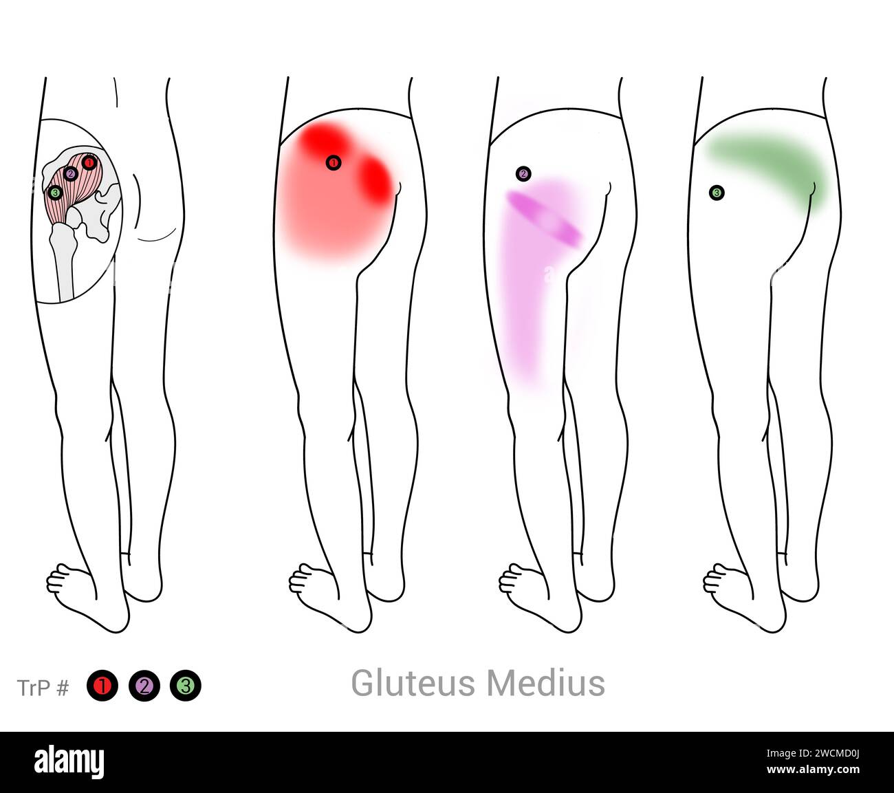 Gluteus Medius: Punti di attivazione miofasciali e punti di dolore associati Foto Stock