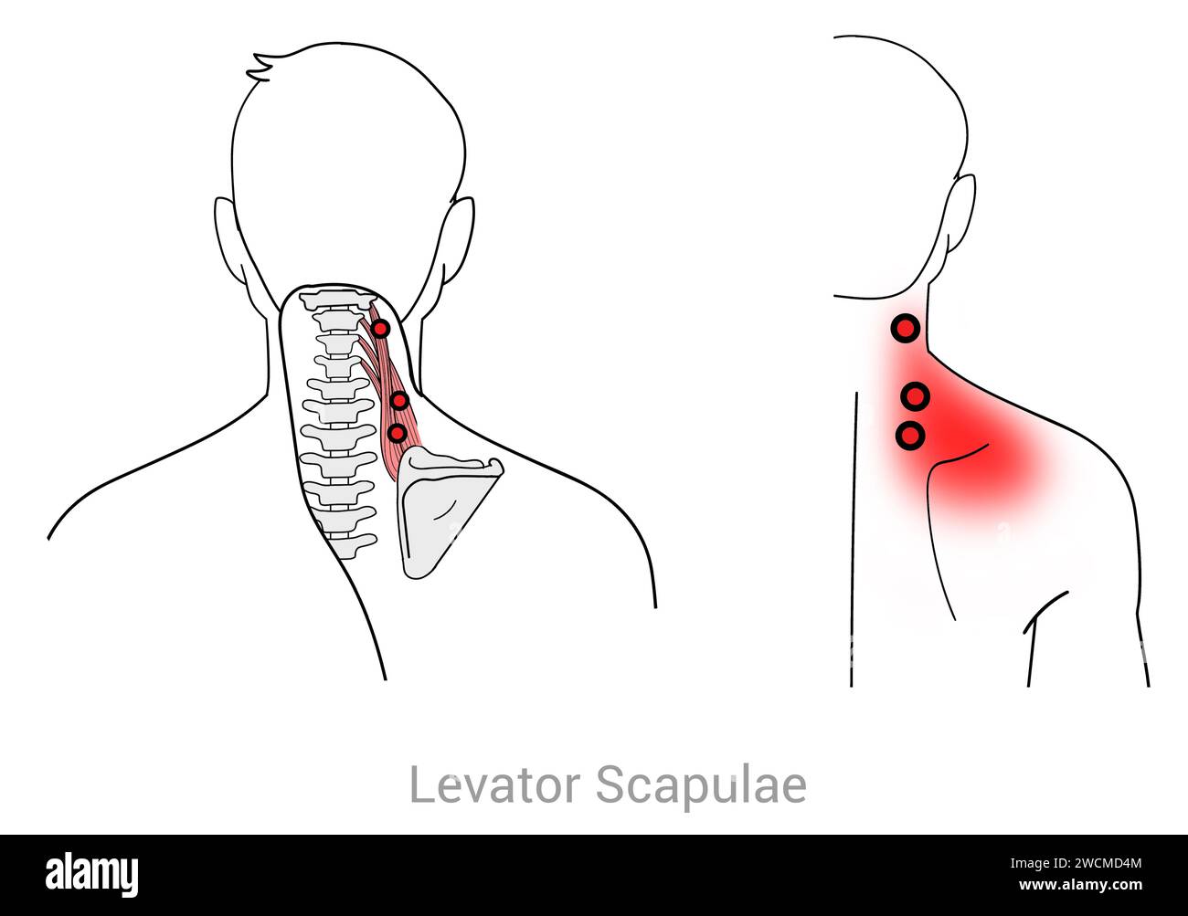 Scapulae del levatore: Punti trigger miofasciali e punti di dolore associati Foto Stock