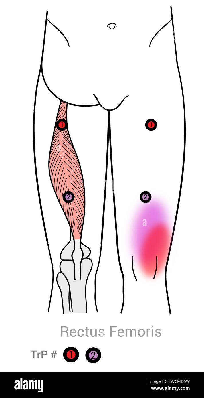 RECTUS Femoris: Punti di trigger miofasciali e punti di dolore associati Foto Stock