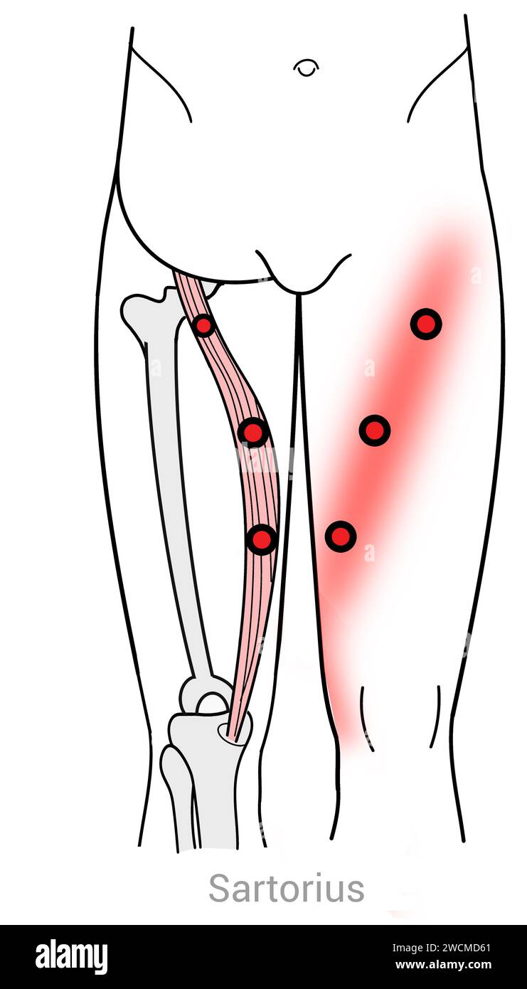 Sartorius: Punti trigger miofasciali e punti di dolore associati Foto Stock