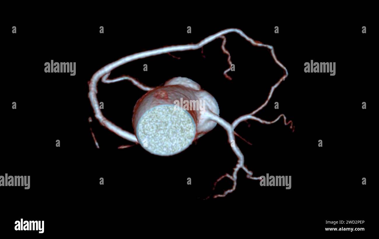 Il rendering 3D dell'arteria coronaria CTA è una tecnica di imaging diagnostico che acquisisce immagini dettagliate dei vasi sanguigni del cuore nella diagnosi dell'arte coronarica Foto Stock