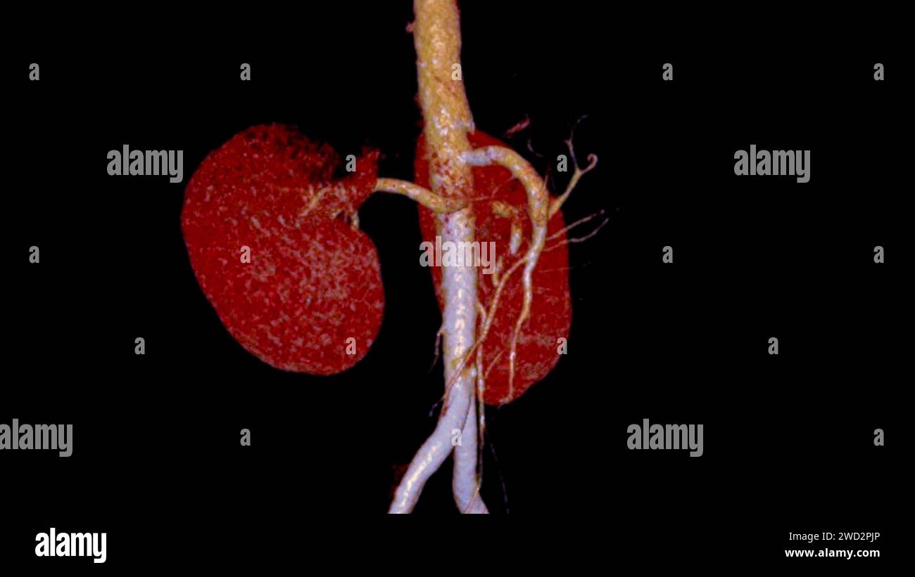 L'arteria renale CTA 3D è una procedura di imaging medico che utilizza scansioni TC per esaminare le arterie renali fornisce immagini dettagliate del suppl dei vasi sanguigni Foto Stock