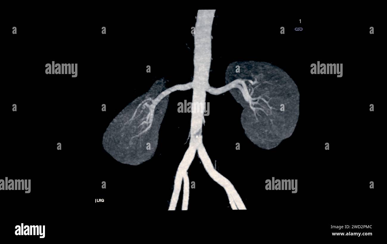 L'arteria renale CTA 3D è una procedura di imaging medico che utilizza scansioni TC per esaminare le arterie renali fornisce immagini dettagliate del suppl dei vasi sanguigni Foto Stock