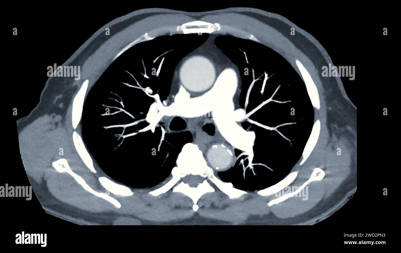 CTPA o CTA arteria polmonare. Questa tecnica di imaging offre una visione chiara delle arterie polmonari, favorendo la diagnosi di embolia polmonare, vas Foto Stock