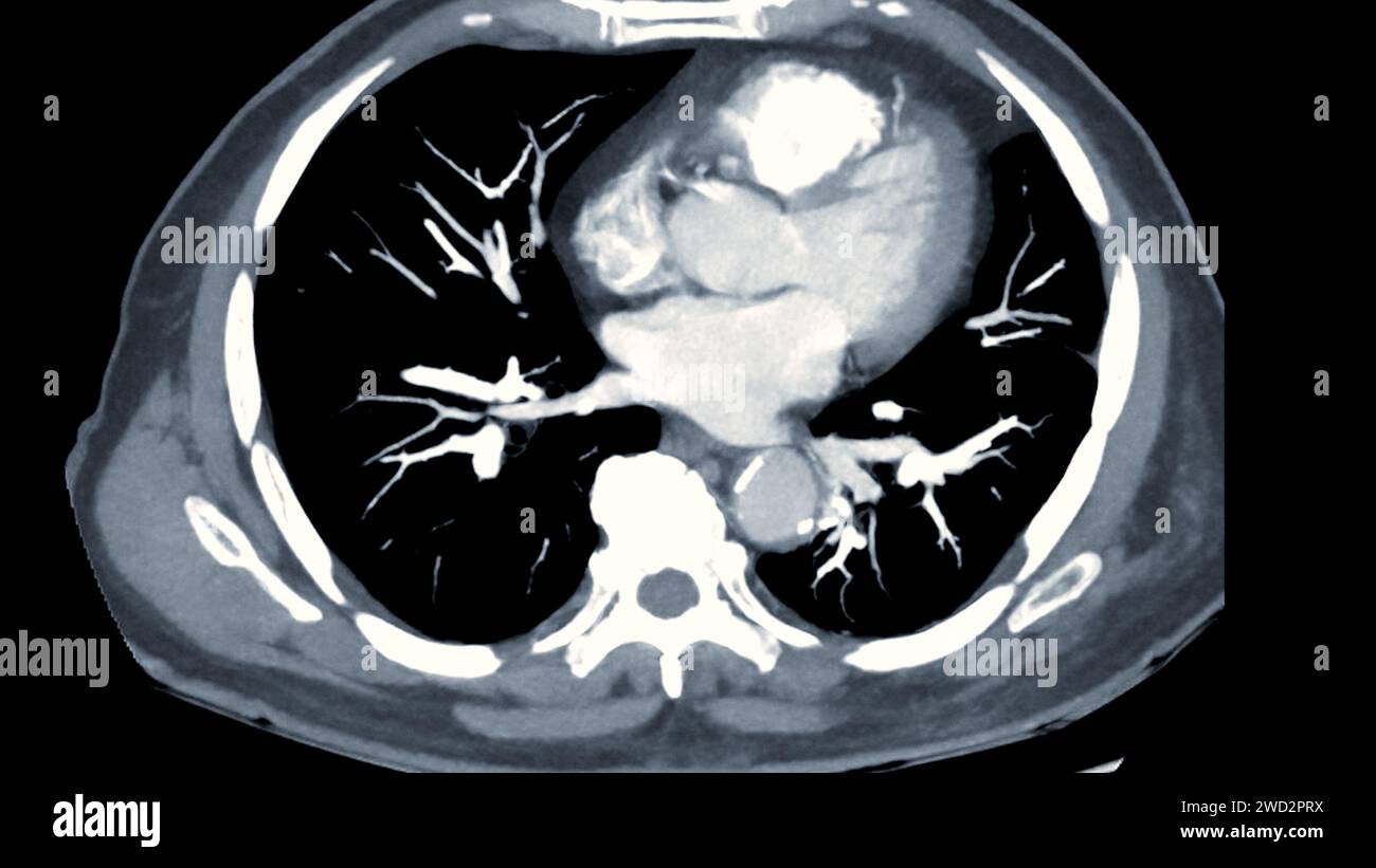 CTPA o CTA arteria polmonare. Questa tecnica di imaging offre una visione chiara delle arterie polmonari, favorendo la diagnosi di embolia polmonare, vas Foto Stock