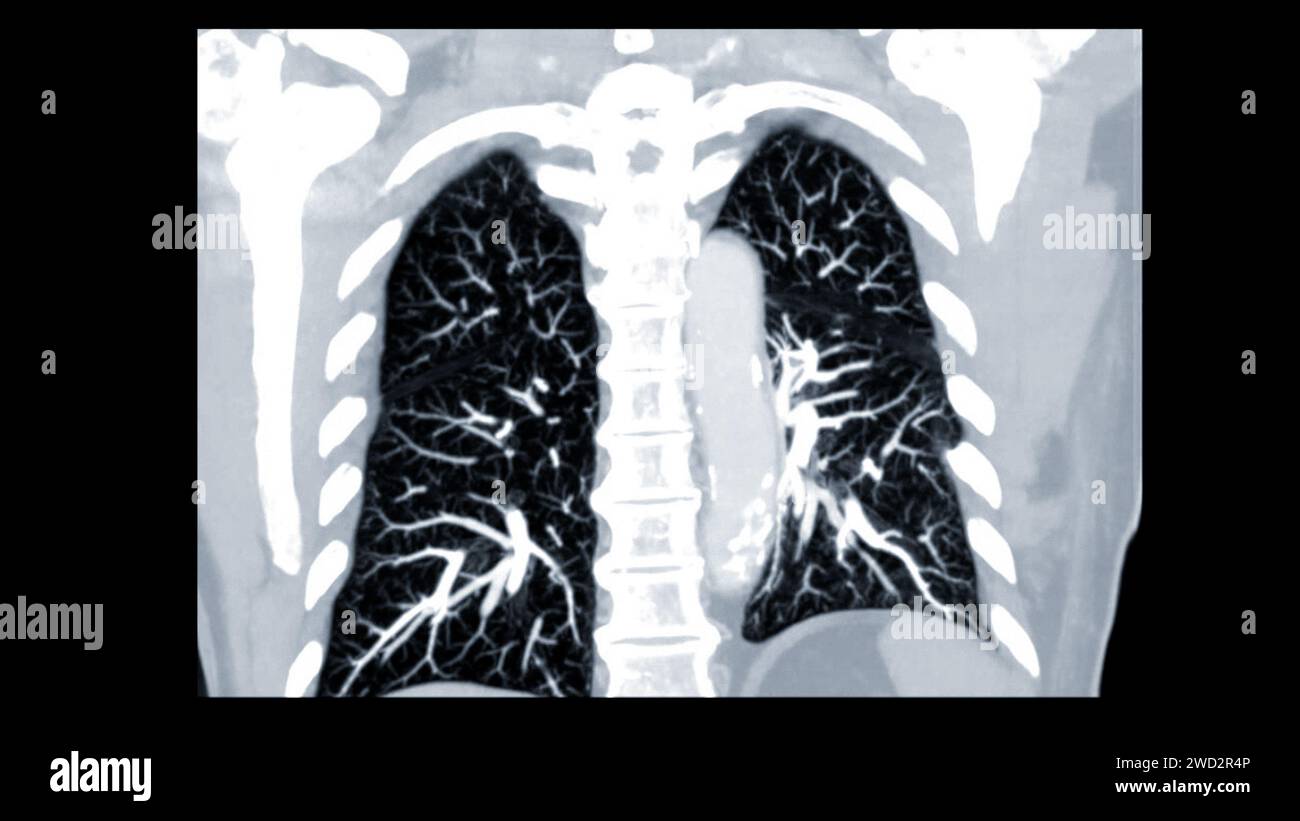 CTPA o CTA arteria polmonare. Questa tecnica di imaging offre una visione chiara delle arterie polmonari, favorendo la diagnosi di embolia polmonare, vas Foto Stock