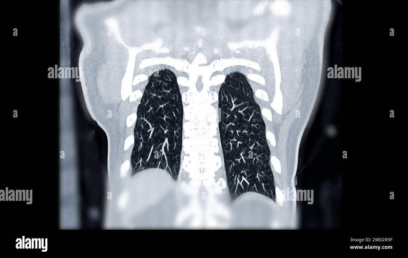 CTPA o CTA arteria polmonare. Questa tecnica di imaging offre una visione chiara delle arterie polmonari, favorendo la diagnosi di embolia polmonare, vas Foto Stock