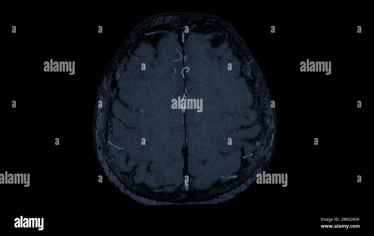 Vista assiale cerebrale MRA , questa tecnica di imaging fornisce una visualizzazione chiara delle strutture arteriose e venose del cervello, favorendo la diagnosi di vascula Foto Stock