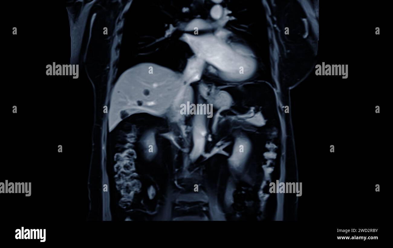 La risonanza magnetica della vista coronale dell'addome superiore è una tecnica di imaging non invasiva che fornisce immagini dettagliate di organi come fegato, pancreas e reni. Foto Stock