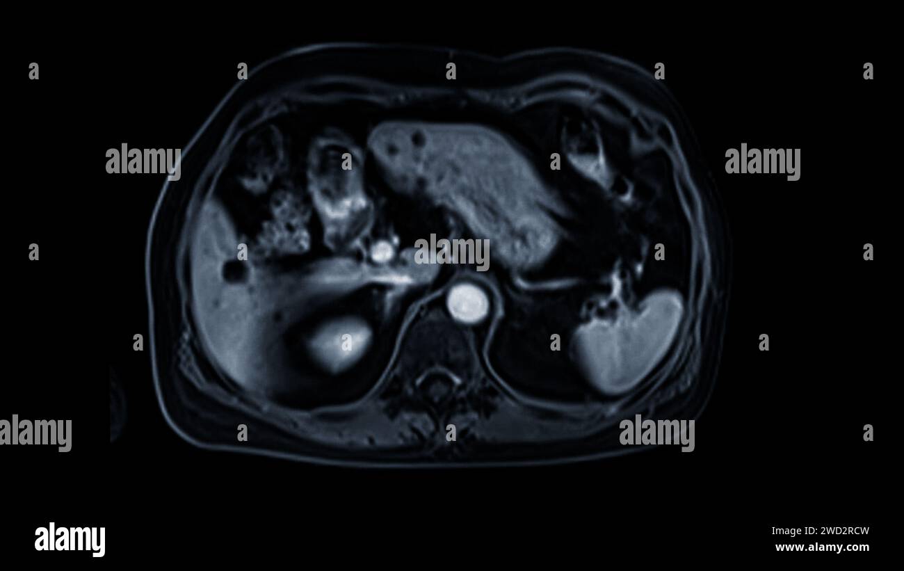 La risonanza magnetica della vista assiale superiore dell'addome è una tecnica di imaging non invasiva che fornisce immagini dettagliate di organi come fegato, pancreas e reni. Foto Stock