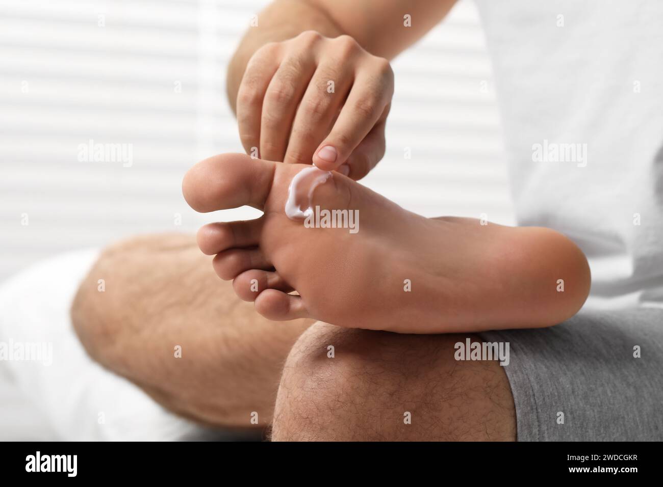 Uomo con pelle secca che applica crema sul piede sul letto, primo piano Foto Stock