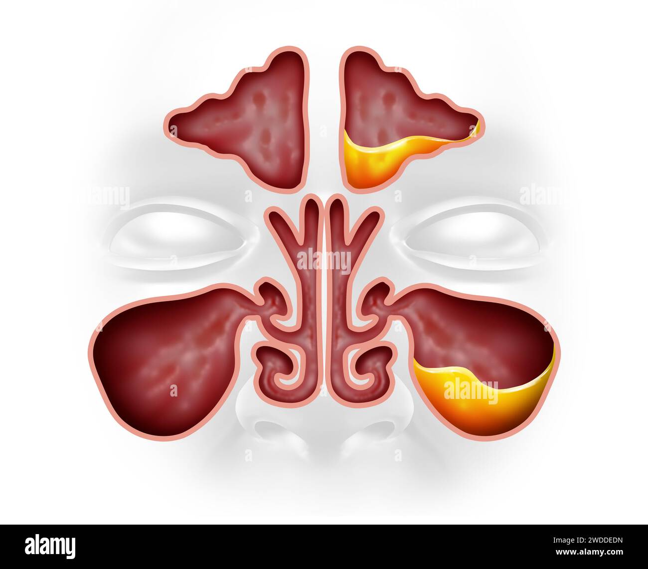Sinusite e seno sano come una malattia di infezione con congestione nasale come una malattia di blocco della cavità con un naso congestionato pieno di muco o pus. Foto Stock