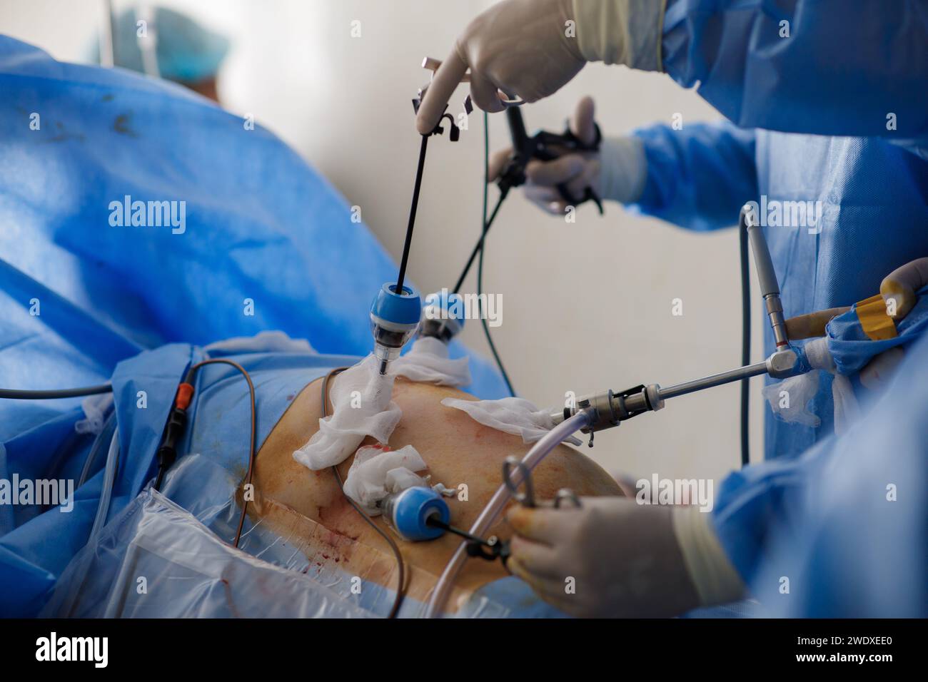 i medici eseguono operazioni laparoscopiche nell'unità di terapia intensiva. Foto di alta qualità Foto Stock
