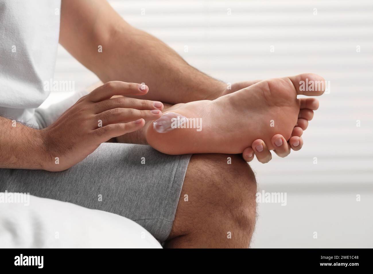 Uomo con pelle secca che applica crema sul piede sul letto, primo piano Foto Stock