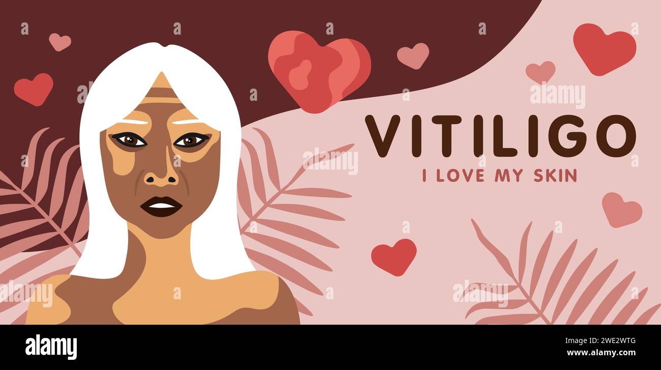 Banner su vitilingo malattia della pelle con anziana donna asiatica, illustrazione vettoriale minimalista, testo amo la mia pelle Illustrazione Vettoriale