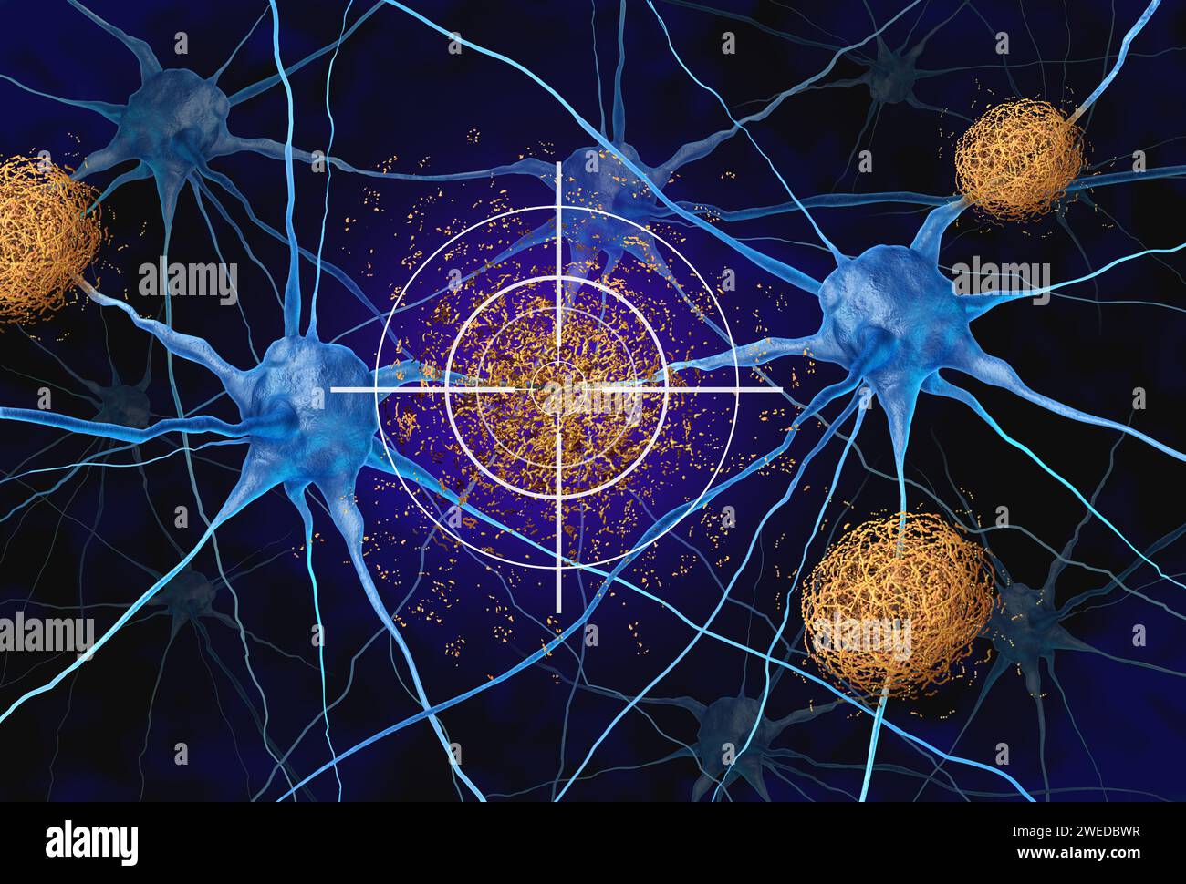 Targeting della placca amiloide come terapia mirata per placche costituite da ammassi anomali di frammenti proteici che si accumulano tra le cellule nervose distrutte Foto Stock