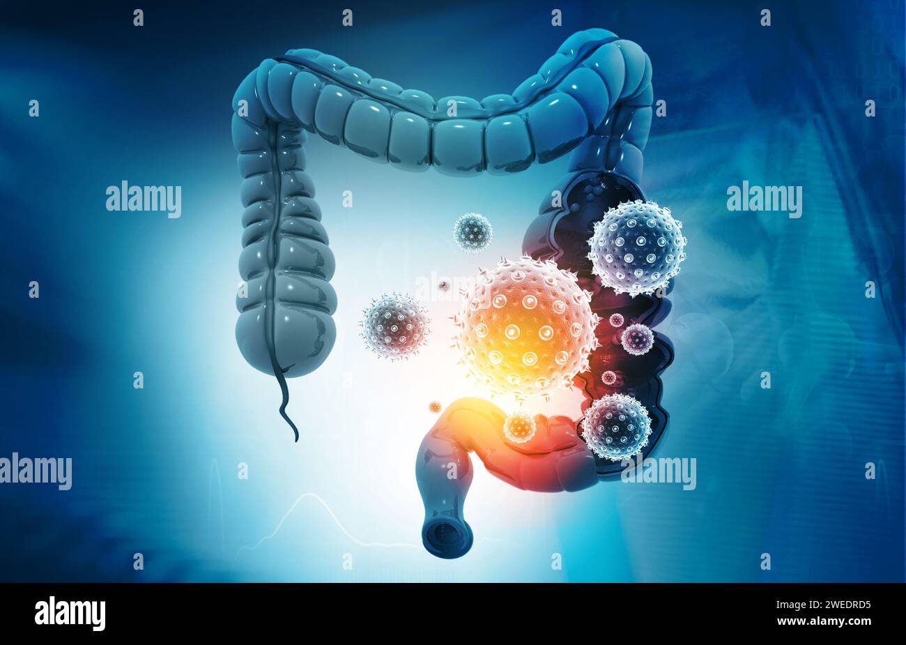 Cancro del colon, batteri, virus nell'intestino malsano malato. illustrazione 3d. Foto Stock