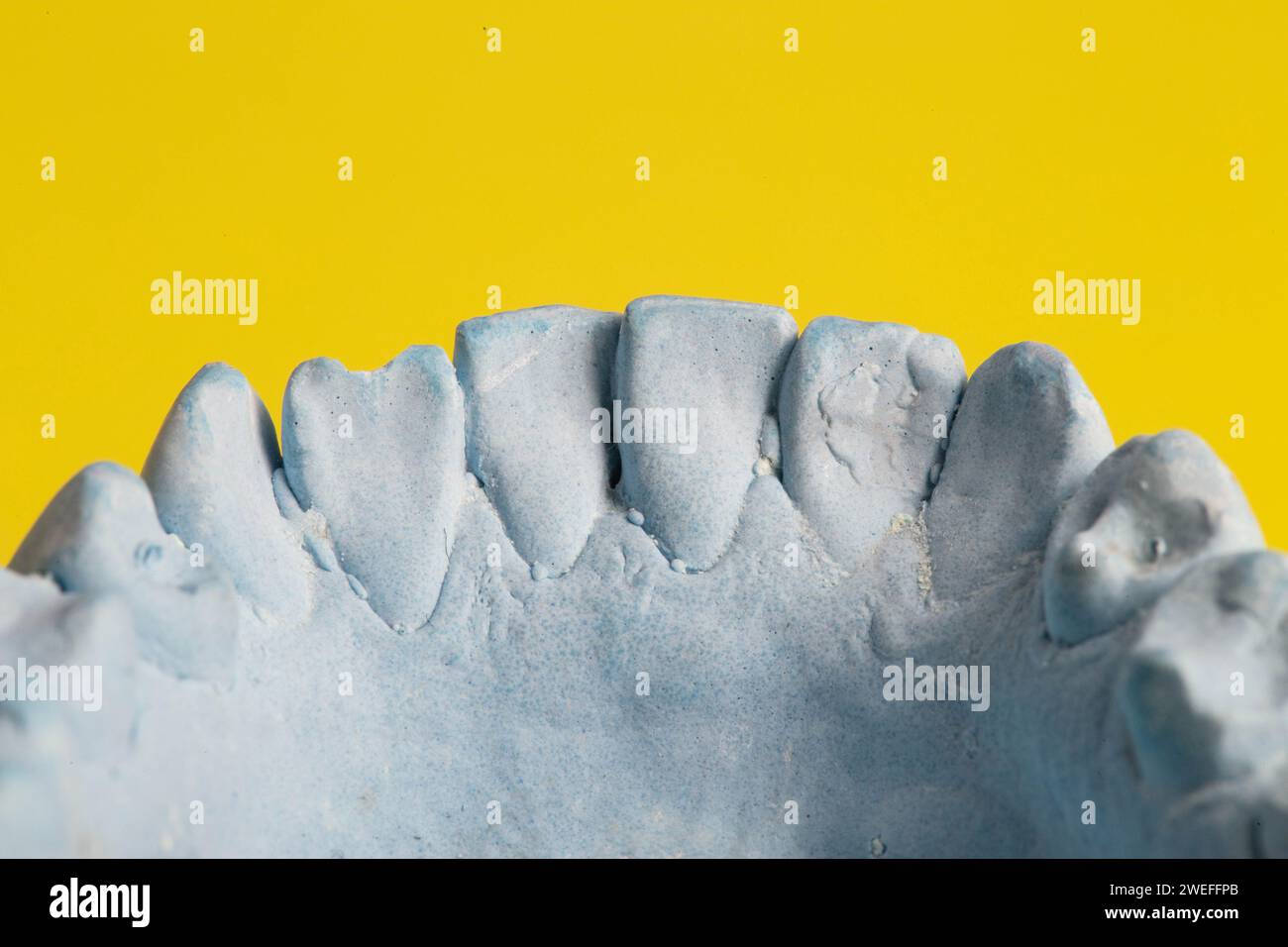Intonaco blu impressione della mascella dentale di un paziente con denti storti e malocclusioni su sfondo giallo. Produzione di controventature per correggere il morso Foto Stock