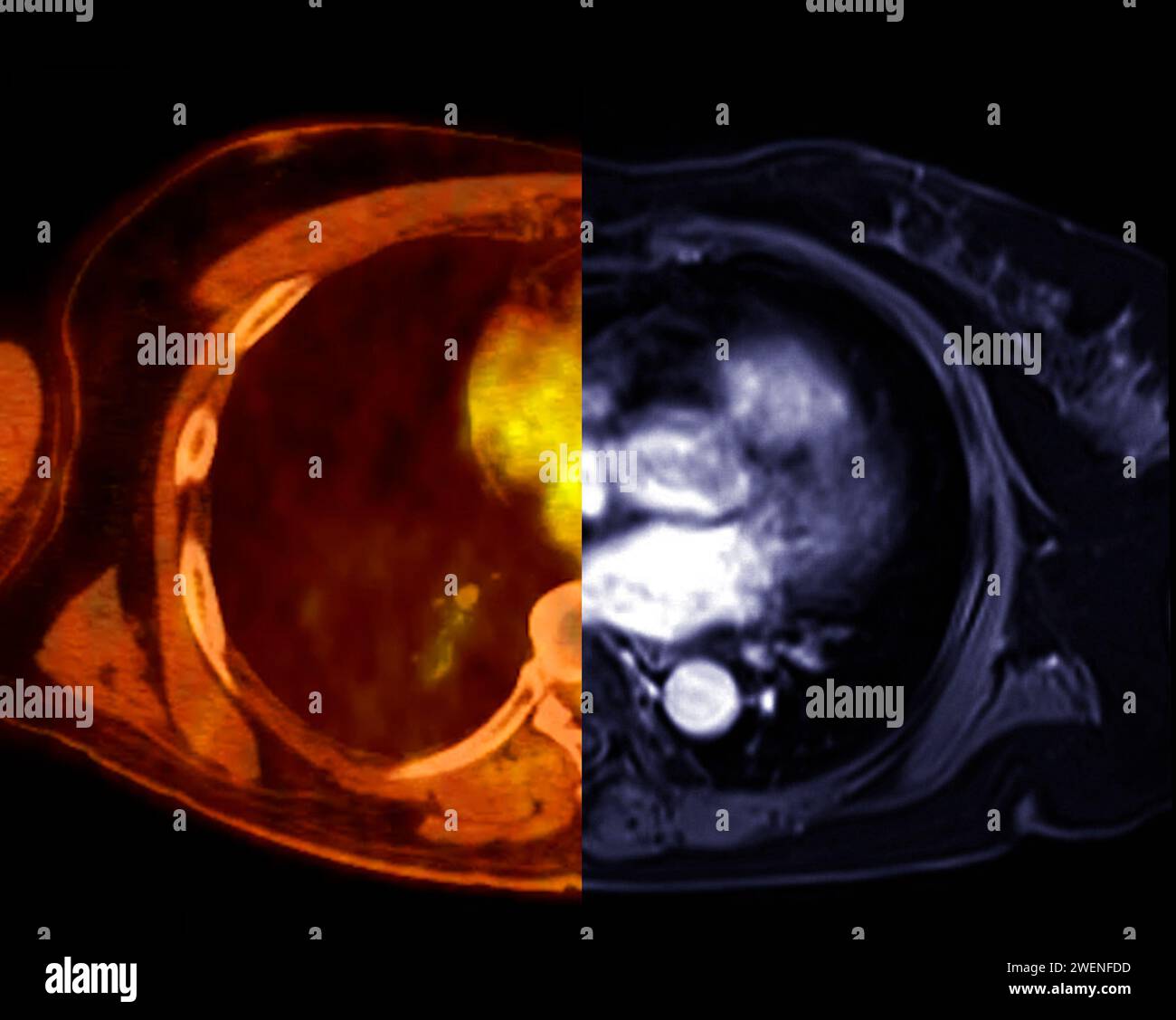Scansione TC della vista assiale torace in modalità colore per embolia polmonare diagnostica (PE), cancro polmonare e covid-19. Foto Stock