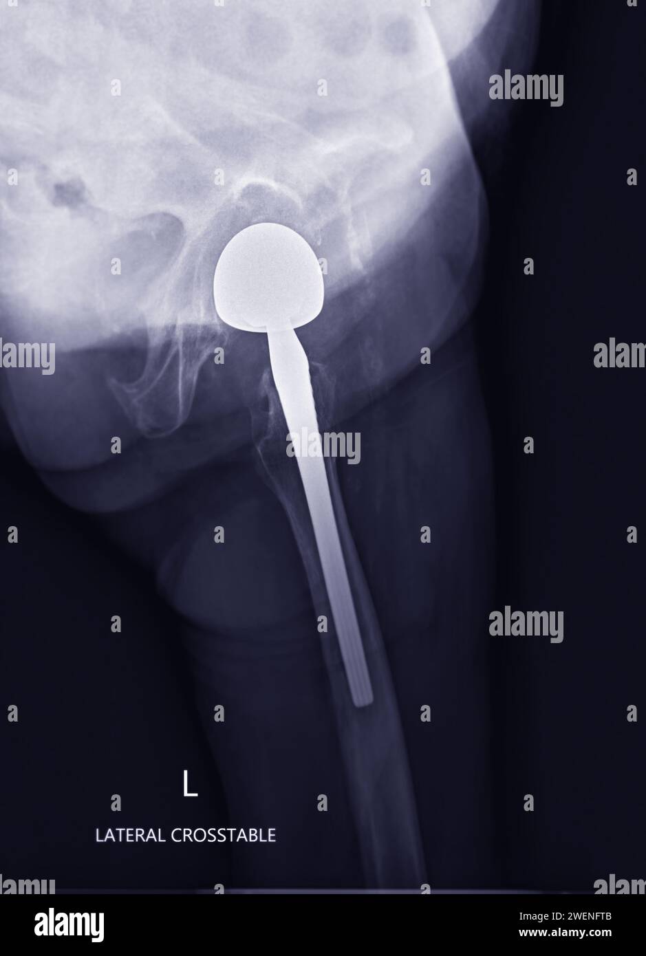 Una radiografia rivela entrambe le articolazioni dell'anca con ARTROPLASTICA DELL'ANCA TOTALE, dimostrando il successo della procedura chirurgica e fornendo un testamento visivo al Foto Stock