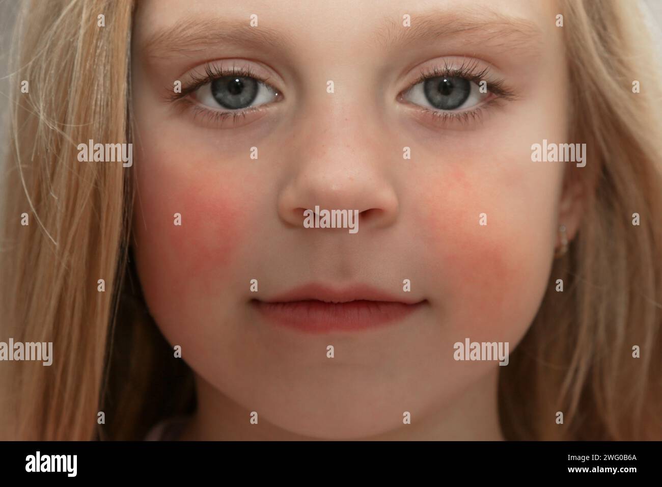 Arrossamento delle guance del bambino causato da eczema, pelle secca o allergia Foto Stock