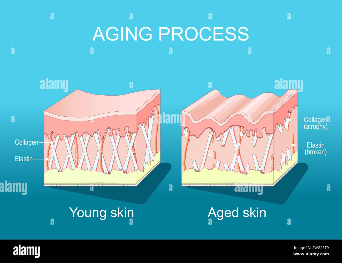 Processo di invecchiamento. confronto tra pelle giovane e invecchiata. Collagene, elastina e fibroblasti nella pelle più giovane e più anziana. Alterazioni cutanee legate all'età quando la Illustrazione Vettoriale