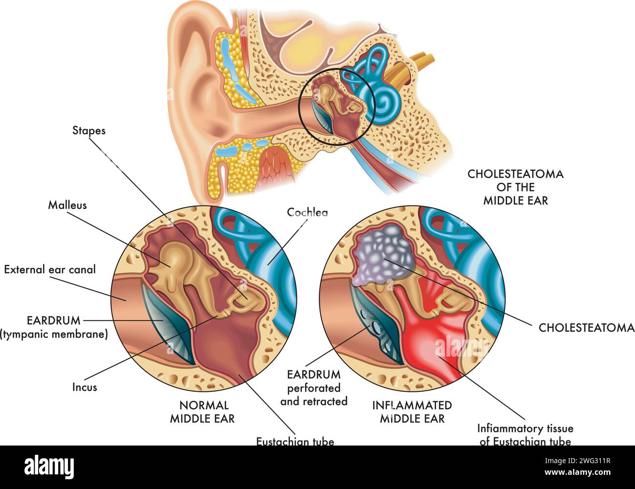 Illustrazione medica che confronta la parte interna dell'orecchio (orecchio medio) a sinistra sana e a destra colpita da colesteatoma, con annotati Illustrazione Vettoriale