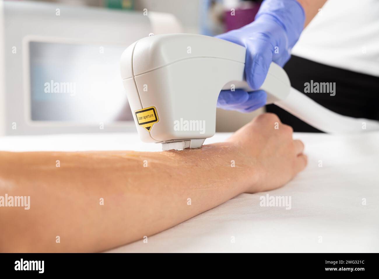 Epilazione laser da mani femminili in un salone di bellezza. Primo piano della procedura di epilazione laser sulle mani di una donna. Foto Stock